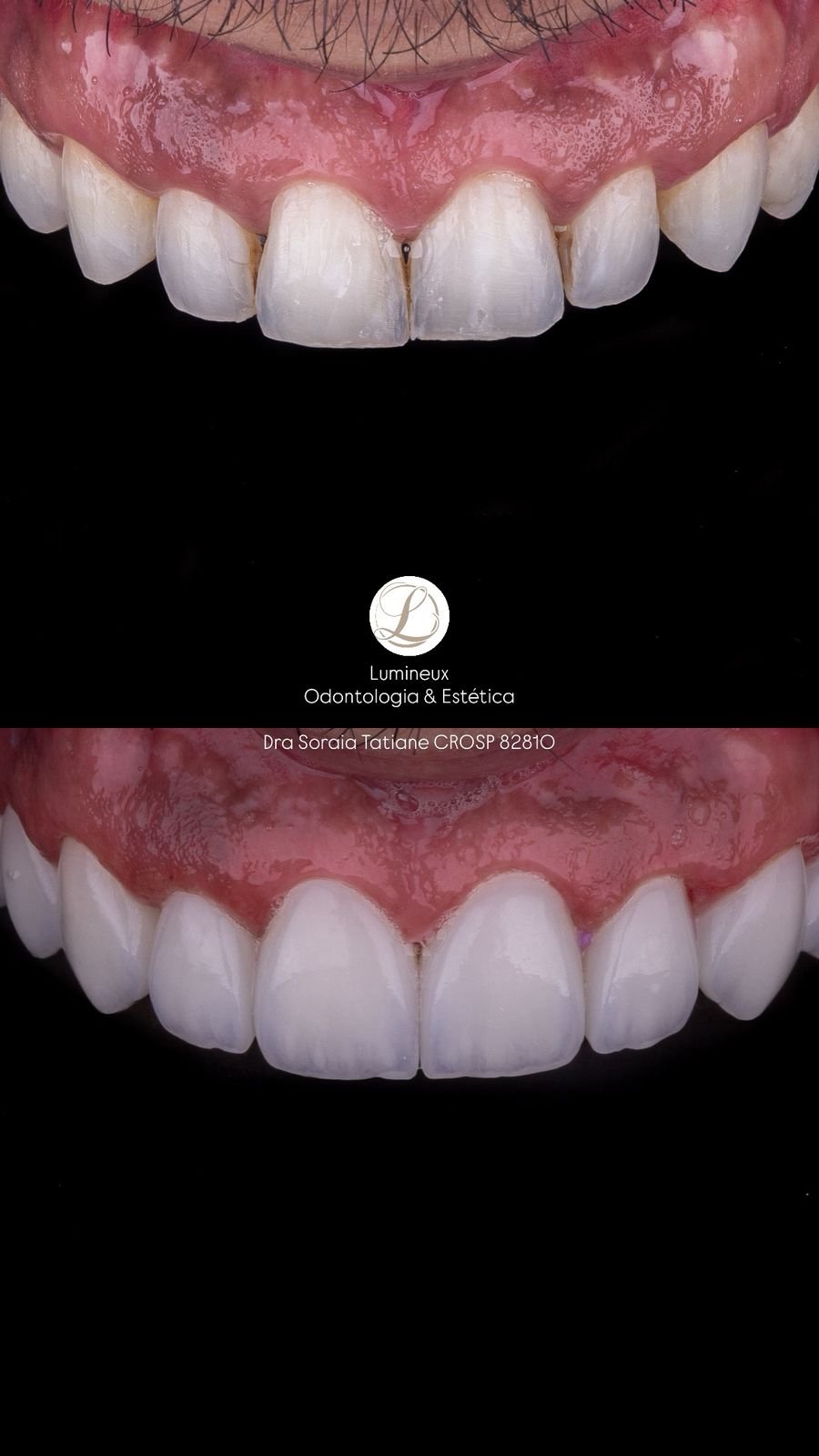 Lente de Contato Dental dentista parque são lucas
