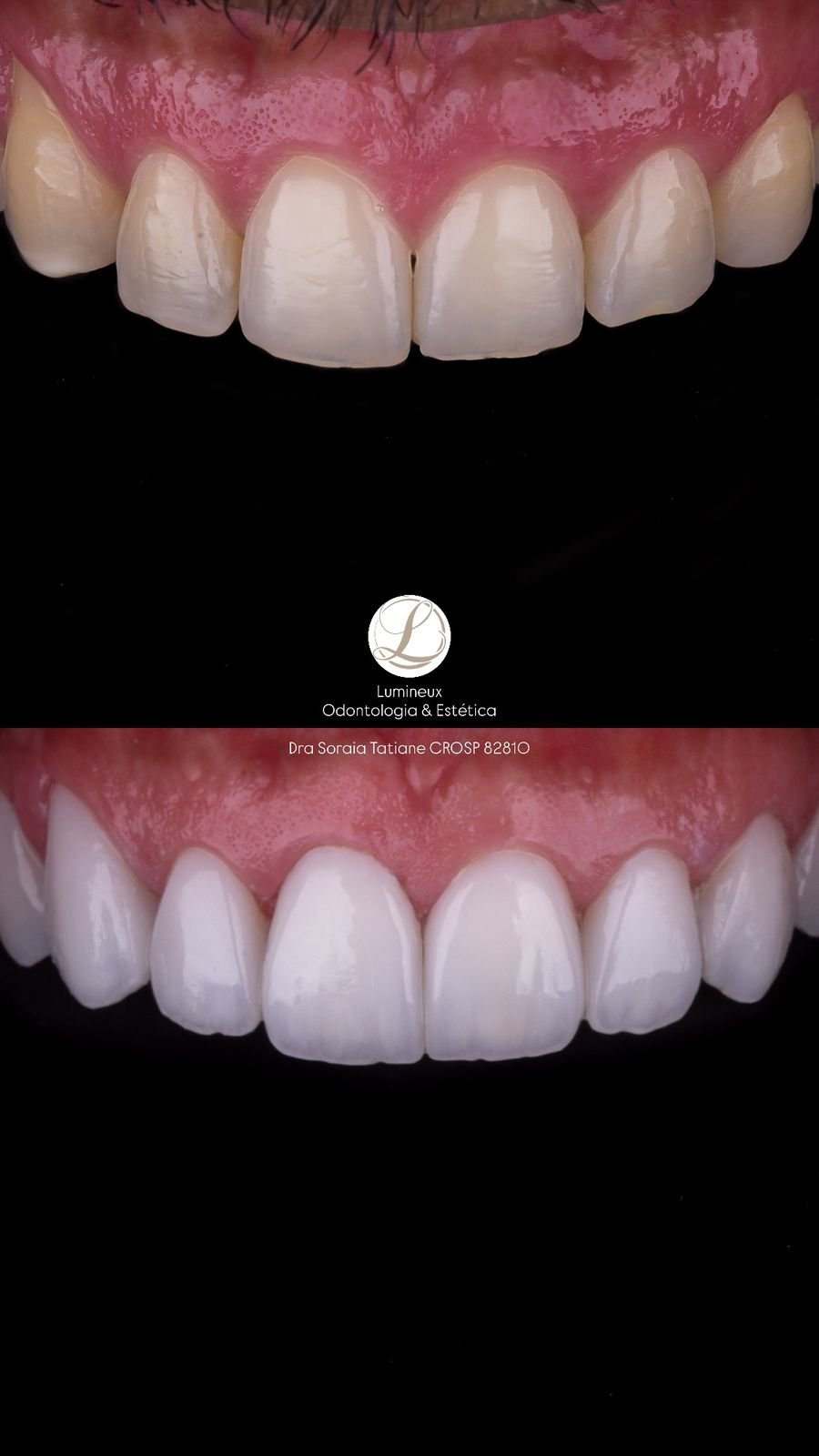 Lente de Contato Dental dentista parque são lucas
