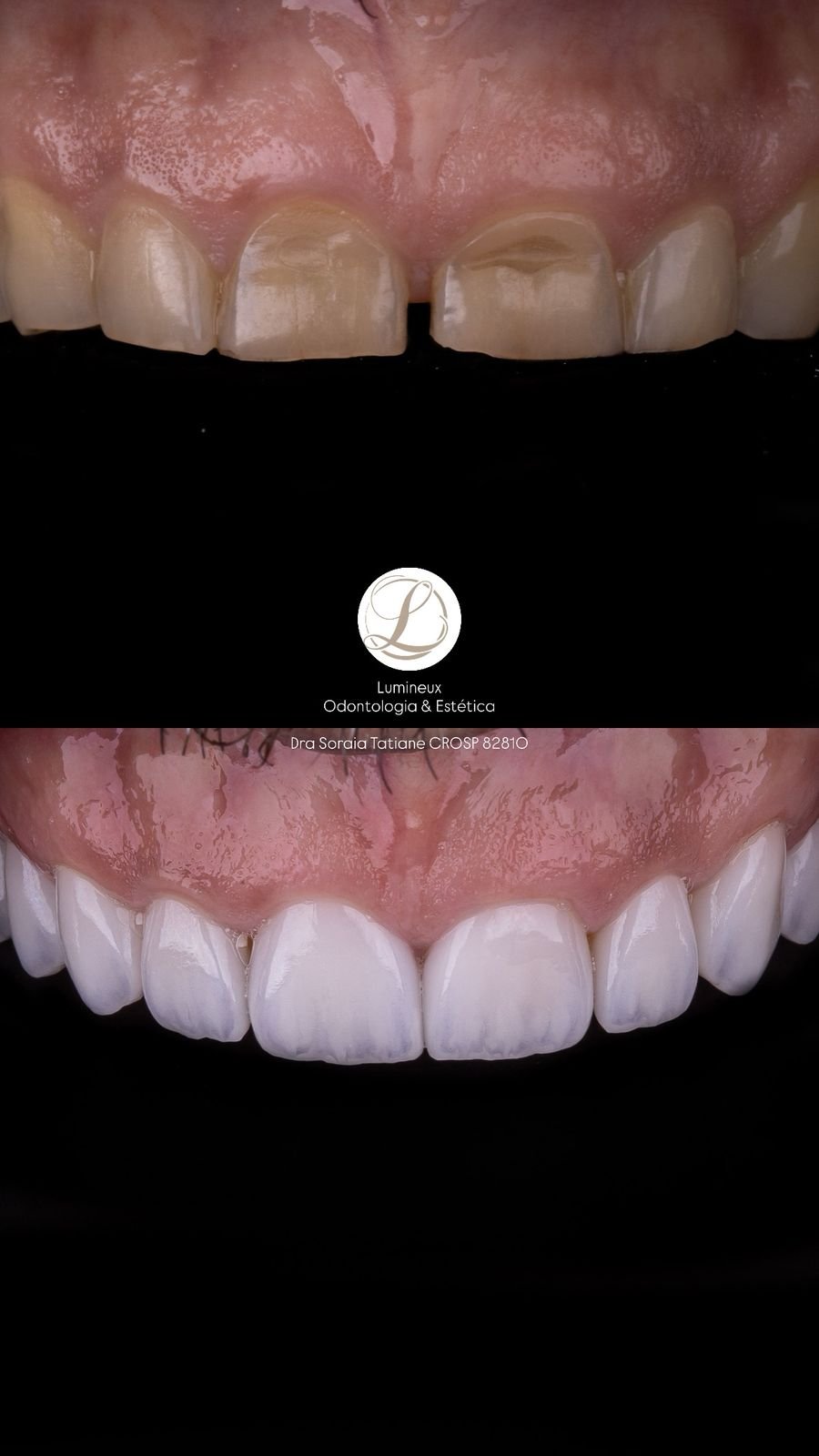 Lente de Contato Dental dentista parque são lucas