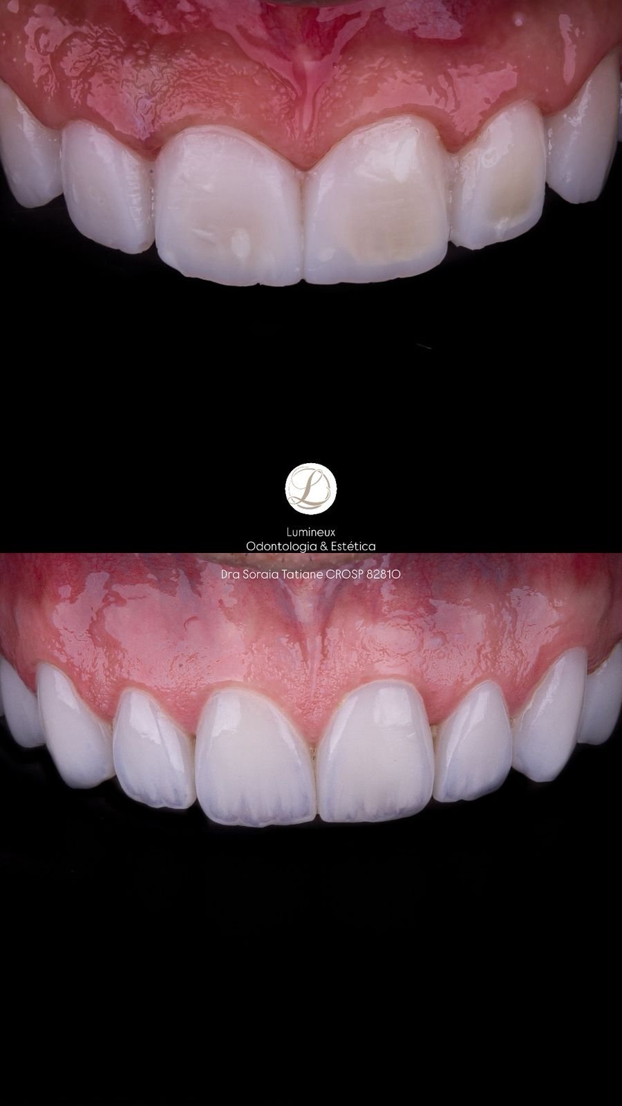 Lente de Contato Dental dentista parque são lucas