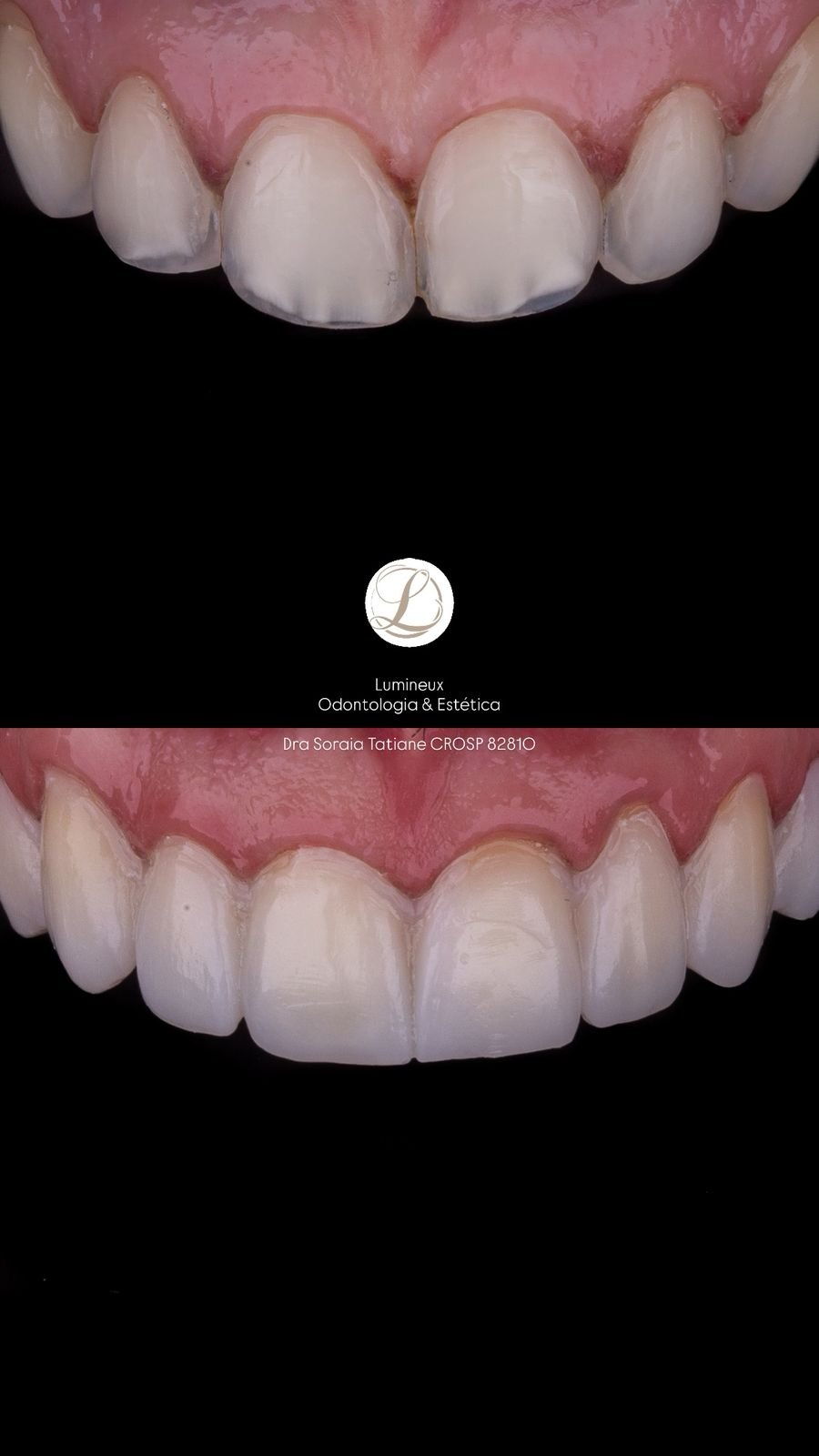 Lente de Contato Dental dentista parque são lucas