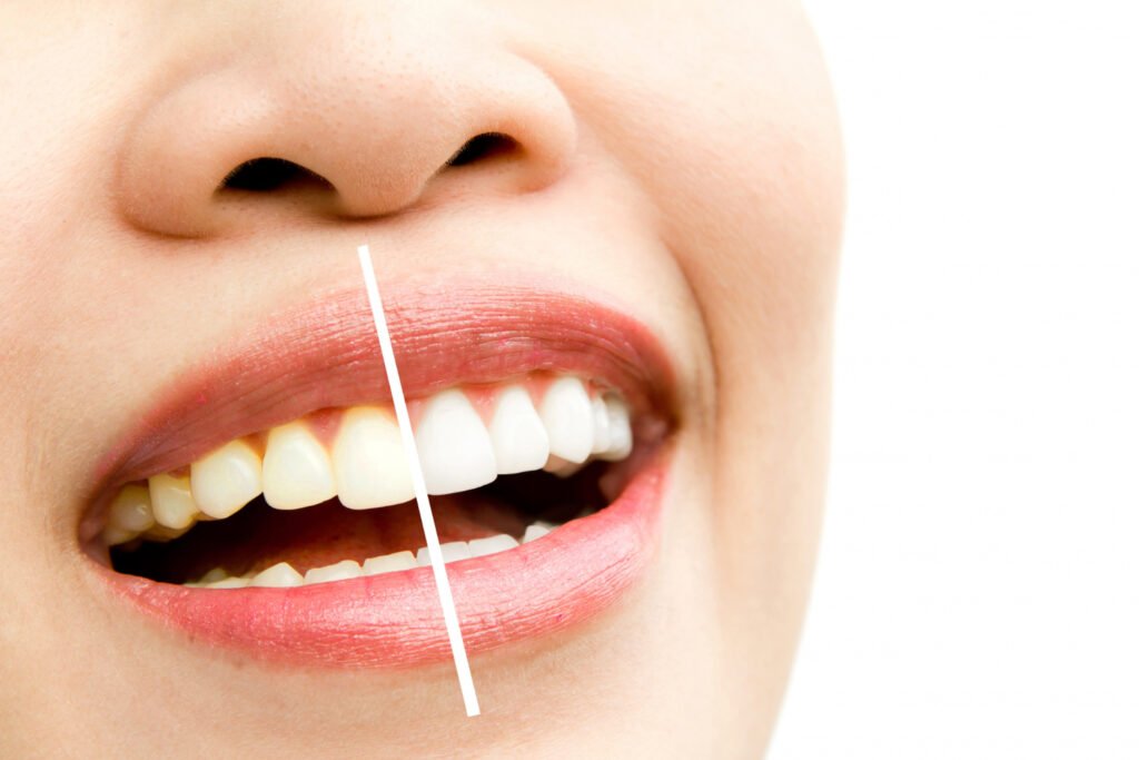 clareamento dental parque são lucas dentista